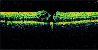 OCT van een maculagat