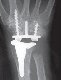 Röntgenfoto van de rechter pols met prothese.