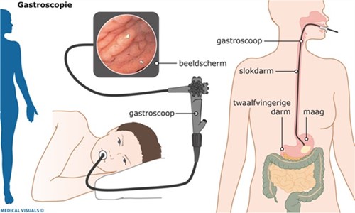 Gastroscopie